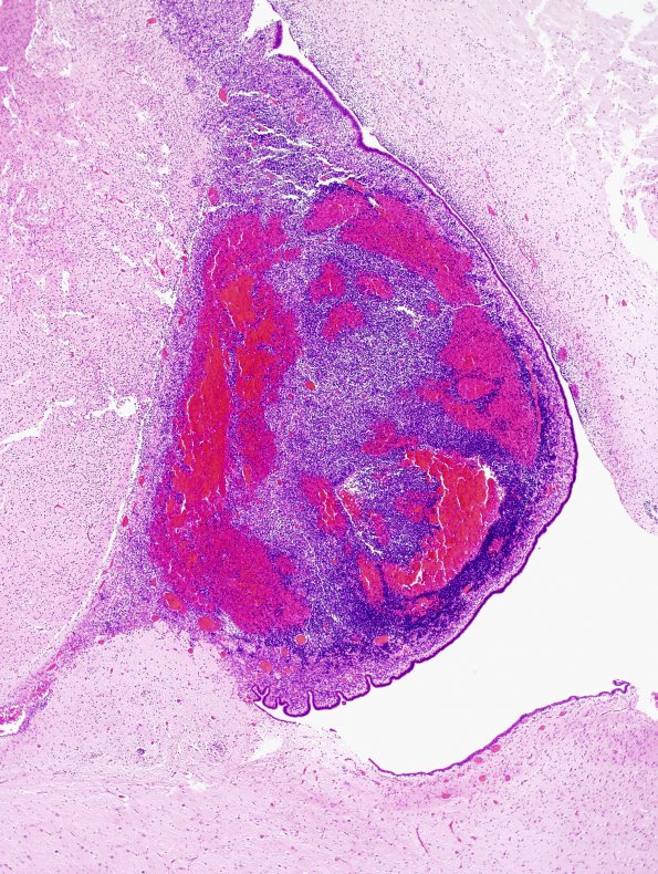 23A3 Hypoxia-Ischemia, Neonate, intrauterine (Case 23) H&E 2