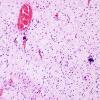 23A4 Hypoxia-Ischemia, Neonate, intrauterine (Case 23) H&E 6