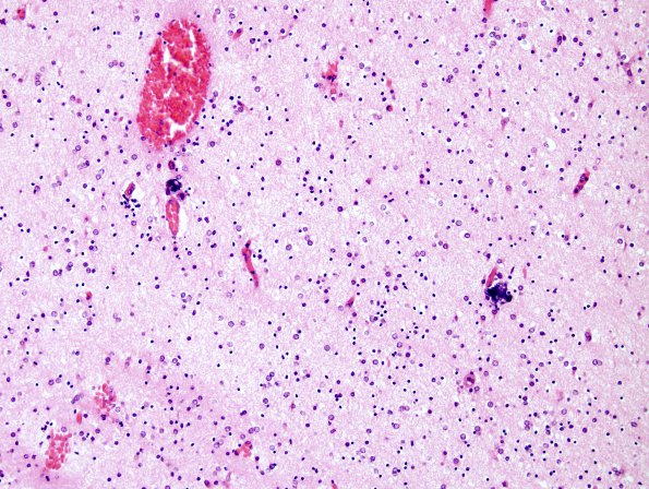 23A4 Hypoxia-Ischemia, Neonate, intrauterine (Case 23) H&E 6