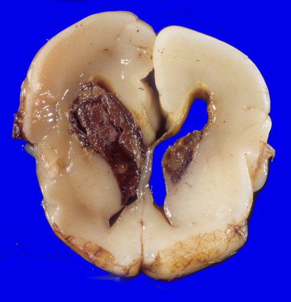 24A1 Hemorrhage, IVH 24-26 wks (Case 24) 1