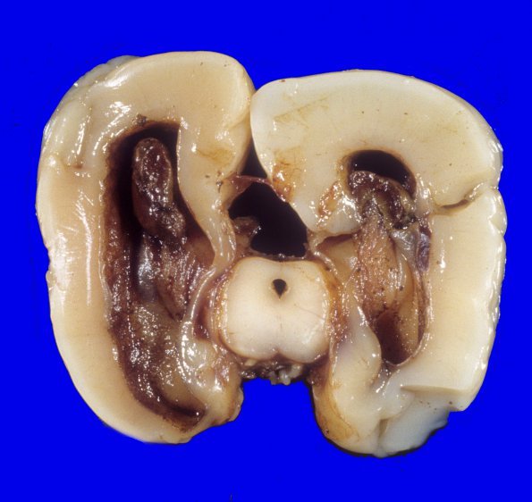 24A2 Hemorrhage, IVH 24-26 wks (Case 24) 2