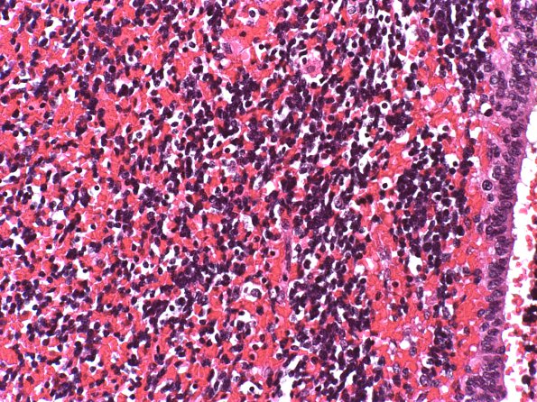 24B2 Hemorrhage, neonatal (Case 24) H&E 2