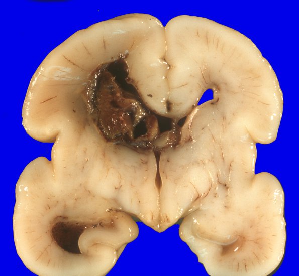 25A1 Hemorrhage, neonatal (Case 25) born 24 wk, intraventricular, 1