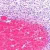 27A2 Hypoxia-Ischemia, premature (Case 27) Germinal Matrix H&E 2