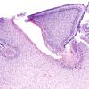 27B1 Hypoxia-Ischemia, premature (Case 27) H&E 5A