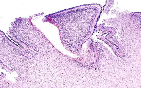 27B1 Hypoxia-Ischemia, premature (Case 27) H&E 5A