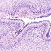 27B2 Hypoxia-Ischemia, premature (Case 27) H&E 1