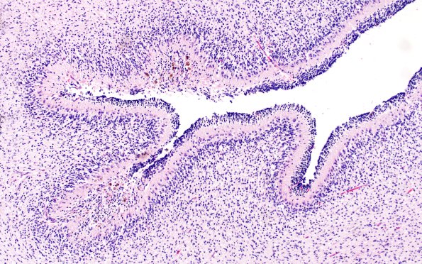 27B2 Hypoxia-Ischemia, premature (Case 27) H&E 1