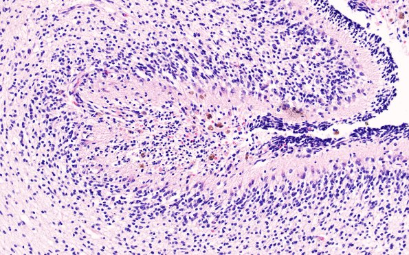 27B3 Hypoxia-Ischemia, premature (Case 27) H&E 2C