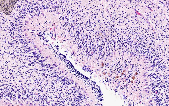 27B4 Hypoxia-Ischemia, premature (Case 27) H&E 3