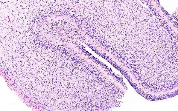 27B5 Hypoxia-Ischemia, premature (Case 27) H&E 4