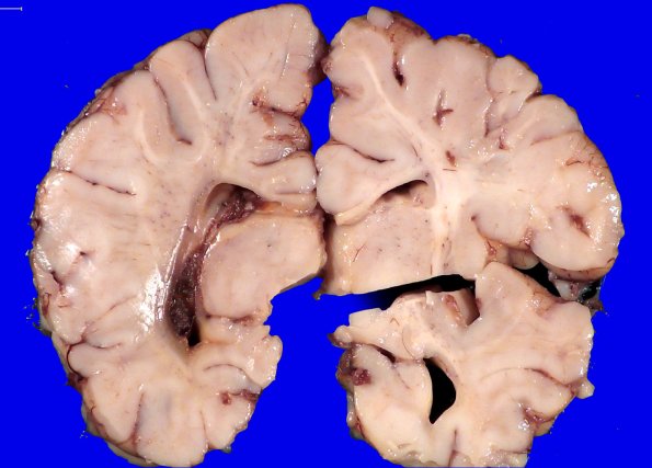 29A1 IVH (Case 29) Gross 1