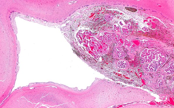 29B2 IVH (Case 29) N11 H&E 2X A