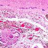 29B3 IVH (Case 29) N11 H&E 10X 2