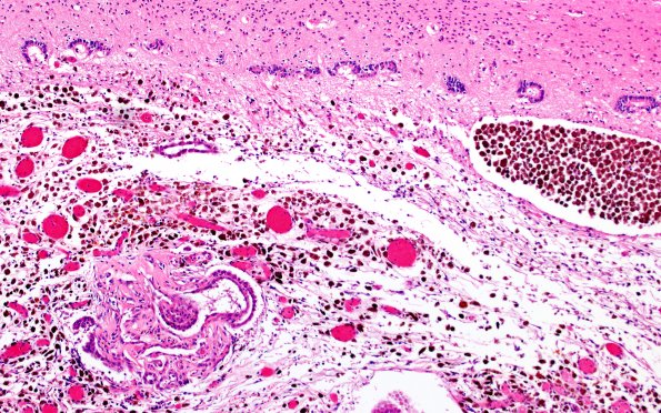 29B3 IVH (Case 29) N11 H&E 10X 2