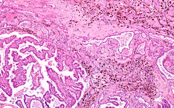 29B5 IVH (Case 29) N11 H&E 10X 3