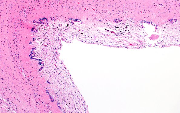 29B6 IVH (Case 29) N11 H&E 10X 4