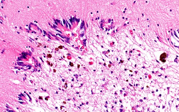 29B7 IVH (Case 29) N11 H&E 40X