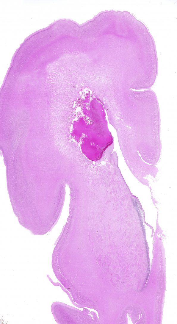 2A1 Hemorrhage, neonatal, SEGM (Case 2) H&E WM