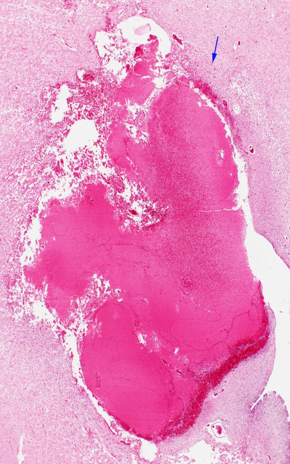 2A2 Hemorrhage, neonatal, SEGM (Case 2) H&E 2X copy