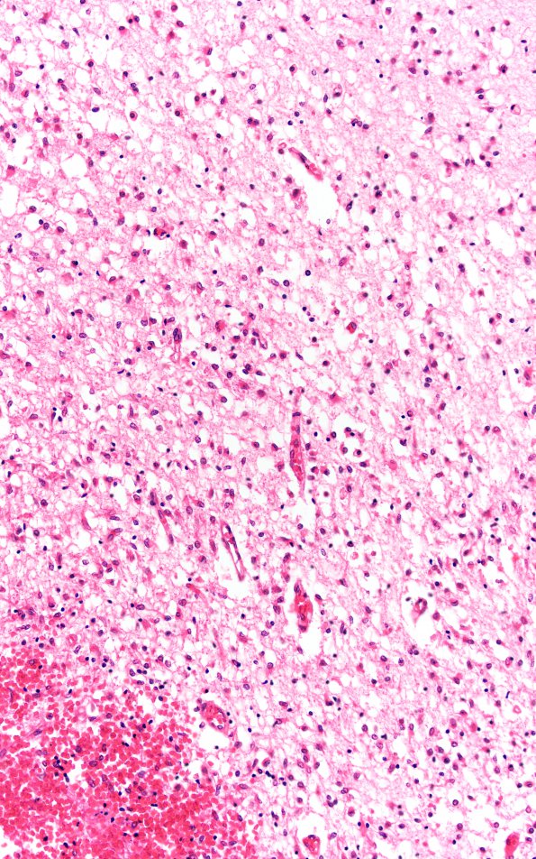 2A3 Hemorrhage, neonatal, SEGM (Case 2) H&E 20X