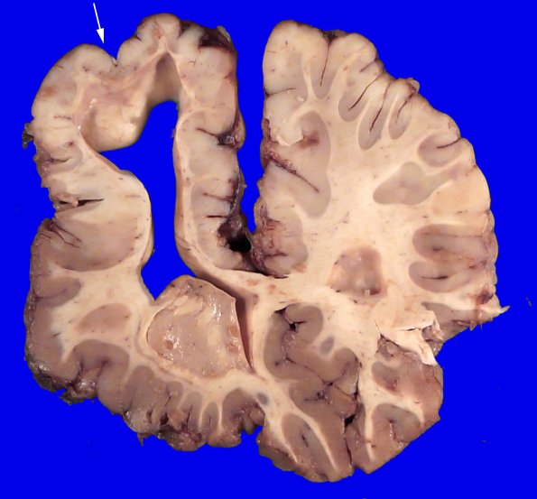 30B4 (Case 30) A