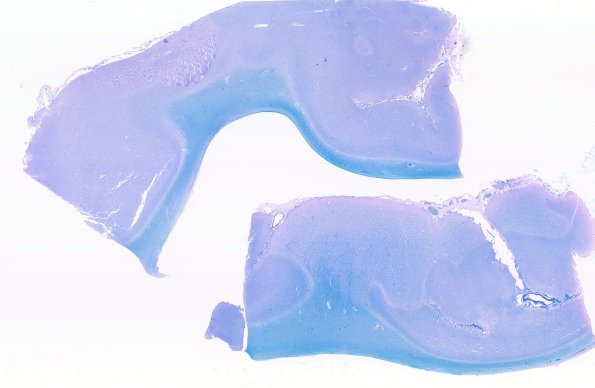 30C8 (Case 30) A11 LFB-PAS WM2