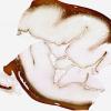 30D5 (Case 30) A15 GFAP WM 2 (R frontoparietal)