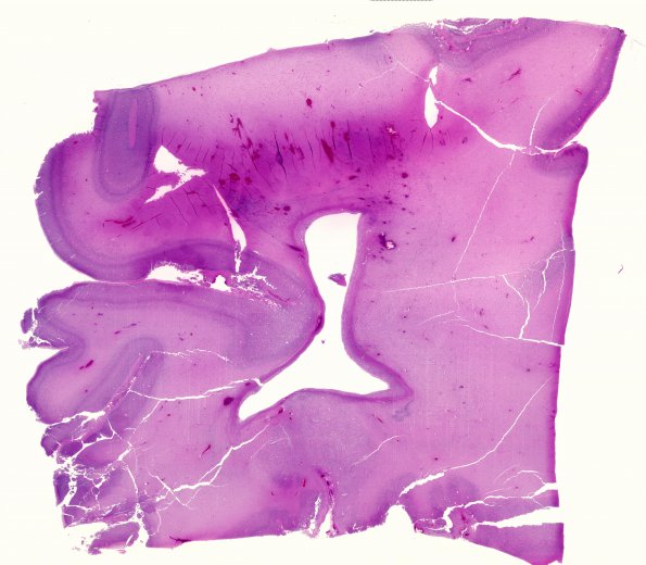 3A2 Hypoxia-Ischemia & SEGM Hemorrhage & EMH (Case 3) H&E whole mount