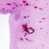 3A3 Hypoxia-Ischemia & SEGM Hemorrhage & EMH (Case 3) H&E 5 copy