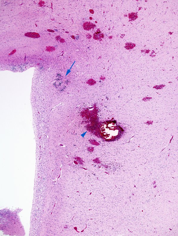 3A3 Hypoxia-Ischemia & SEGM Hemorrhage & EMH (Case 3) H&E 5 copy