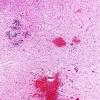 3A4 Hypoxia-Ischemia & SEGM Hemorrhage & EMH (Case 3) H&E 8 (2)