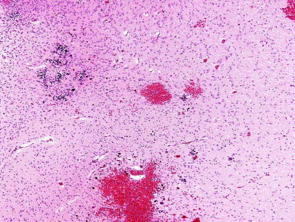 3A4 Hypoxia-Ischemia & SEGM Hemorrhage & EMH (Case 3) H&E 8 (2)