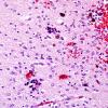 3A5 Hypoxia-Ischemia & SEGM Hemorrhage & EMH (Case 3) H&E 1