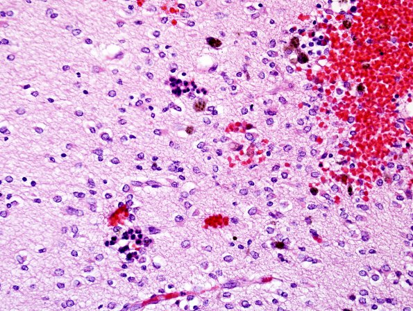 3A5 Hypoxia-Ischemia & SEGM Hemorrhage & EMH (Case 3) H&E 1