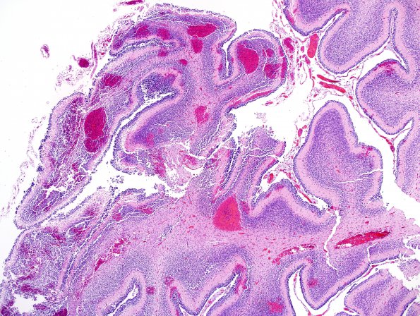 3B1 Hemorrhage, neonatal (Case 3) H&E 3