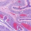 3B2 Hemorrhage, neonatal (Case 3) H&E 1