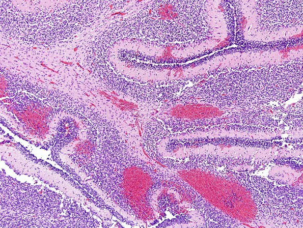 3B2 Hemorrhage, neonatal (Case 3) H&E 1