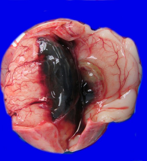 4A1 Hemorrhage, intraventricular 25 weeks (Case 4) _2