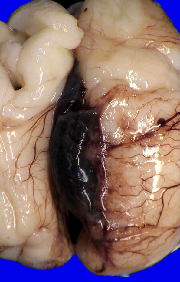 4A2 Hemorrhage, intraventricular 25 weeks (Case 4) _6