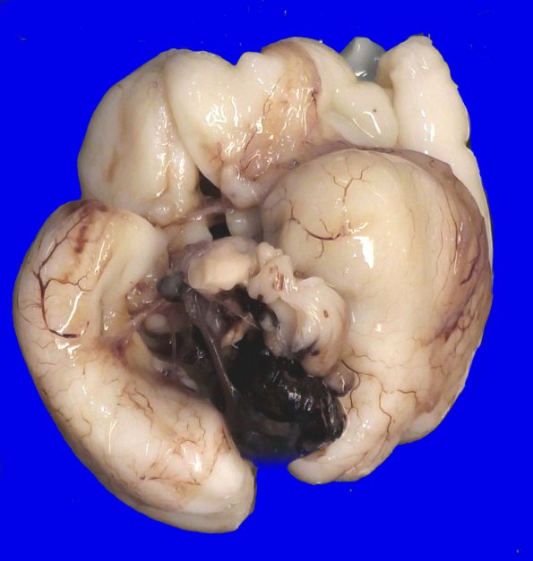 4A3 Hemorrhage, intraventricular 25 weeks (Case 4) _4