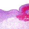 4B1 Hemorrhage, IVH & SEGM (Case 4) H&E 1