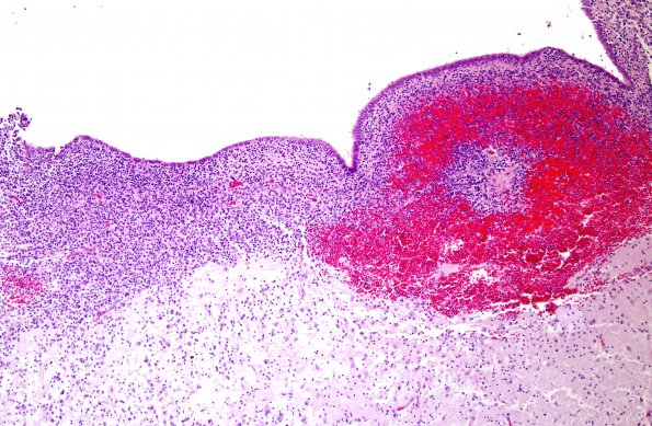 4B1 Hemorrhage, IVH & SEGM (Case 4) H&E 1