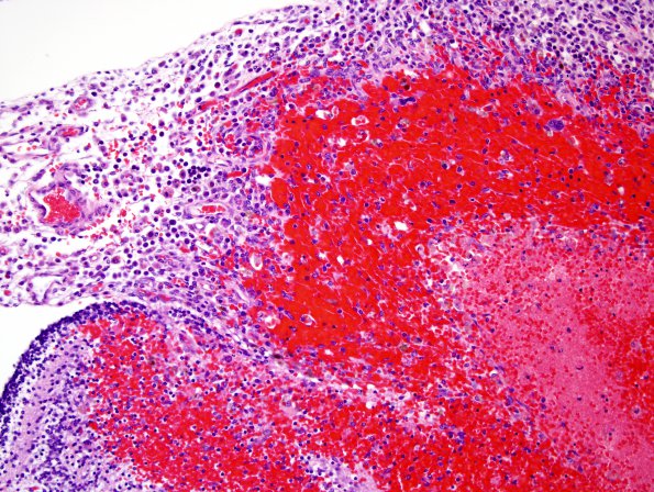 4B2 Hemorrhage, IVH & SEGM (Case 4) H&E 3