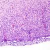 4B3 Hemorrhage, IVH & SEGM (Case 4) H&E 4