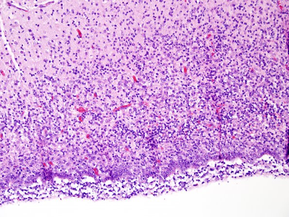 4B3 Hemorrhage, IVH & SEGM (Case 4) H&E 4