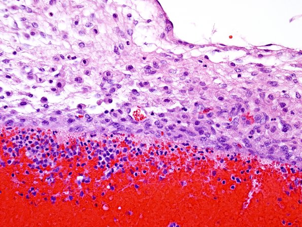 4B4 Hemorrhage, IVH & SEGM (Case 4) Subpial H&E 2