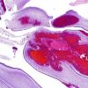 4C2 Hemorrhage, IVH & SEGM (Case 4) H&E 2