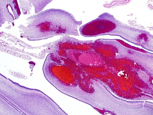 4C2 Hemorrhage, IVH & SEGM (Case 4) H&E 2