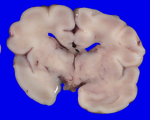 5A1 Hemorrhage, neonatal (Case 5)